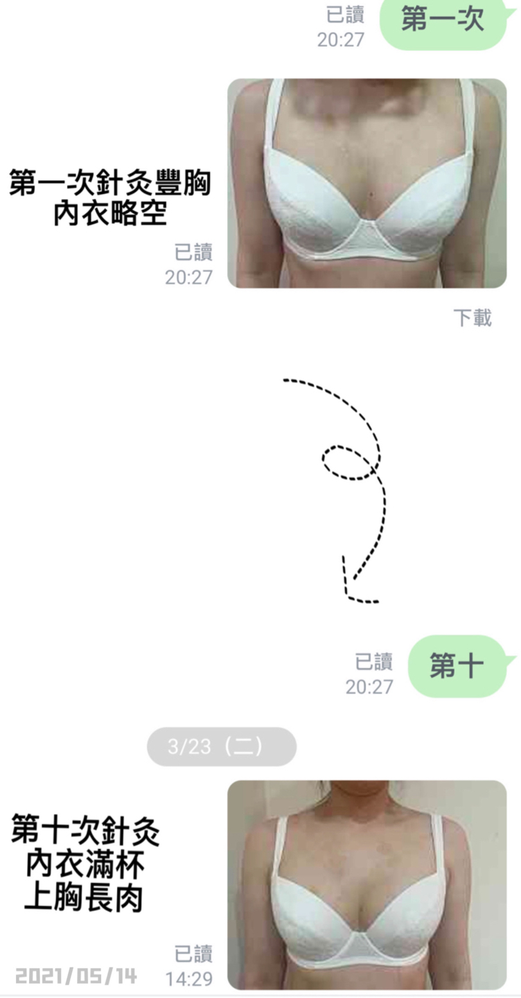 針灸豐胸....上胸空杯不好看