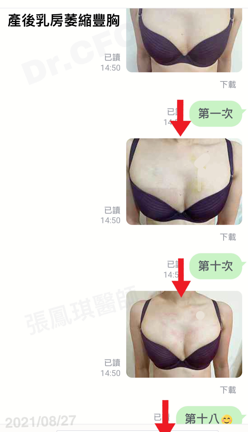 A奶媽媽產後乳房萎縮豐胸