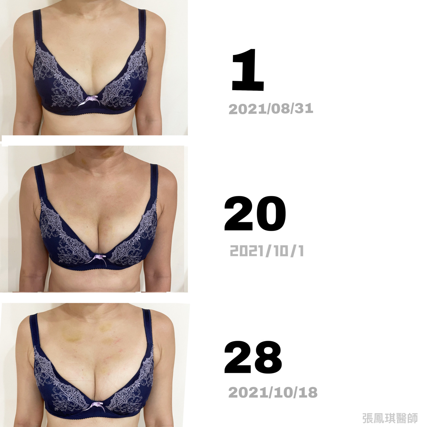 針灸豐胸  75b-->75d爆乳